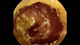 Pill Camera Swallowed | Follow Through Gut | Guts | Earth Lab