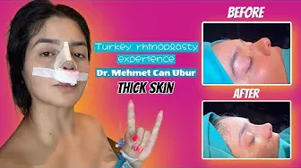 I got my nose done by Turkeys BEST thick skin rhinoplasty doctor MEHMET CAN UBUR