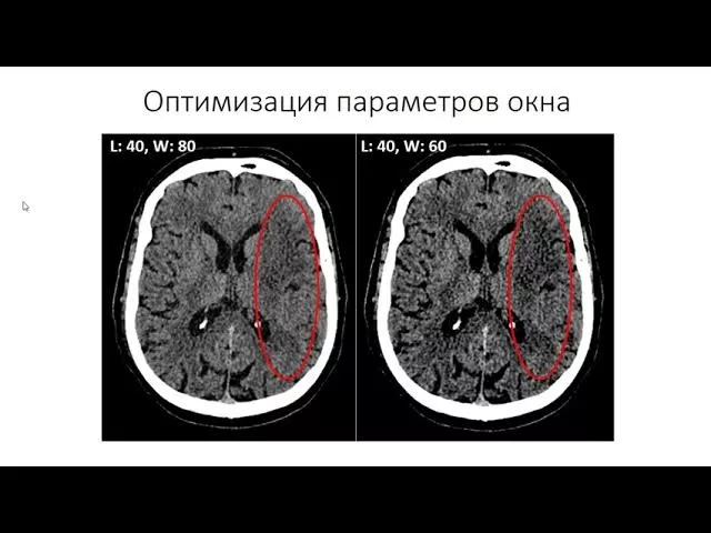 Лекция 6.2  Острейшая стадия инфаркта головного мозга