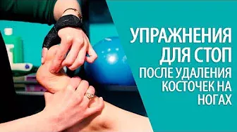 УПРАЖНЕНИЯ ДЛЯ СТОП после удаления косточек на ногах HALLUX VALGUS Алексей Олейник