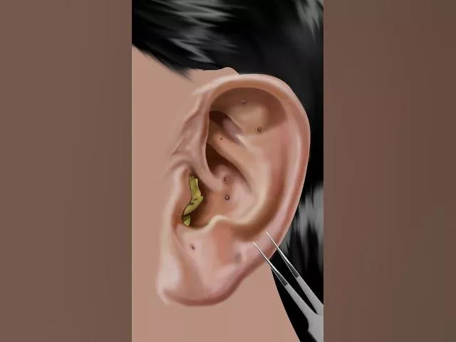 #asmr Itchy & Smelly Ear Stone Removal #animation #beauty #ear