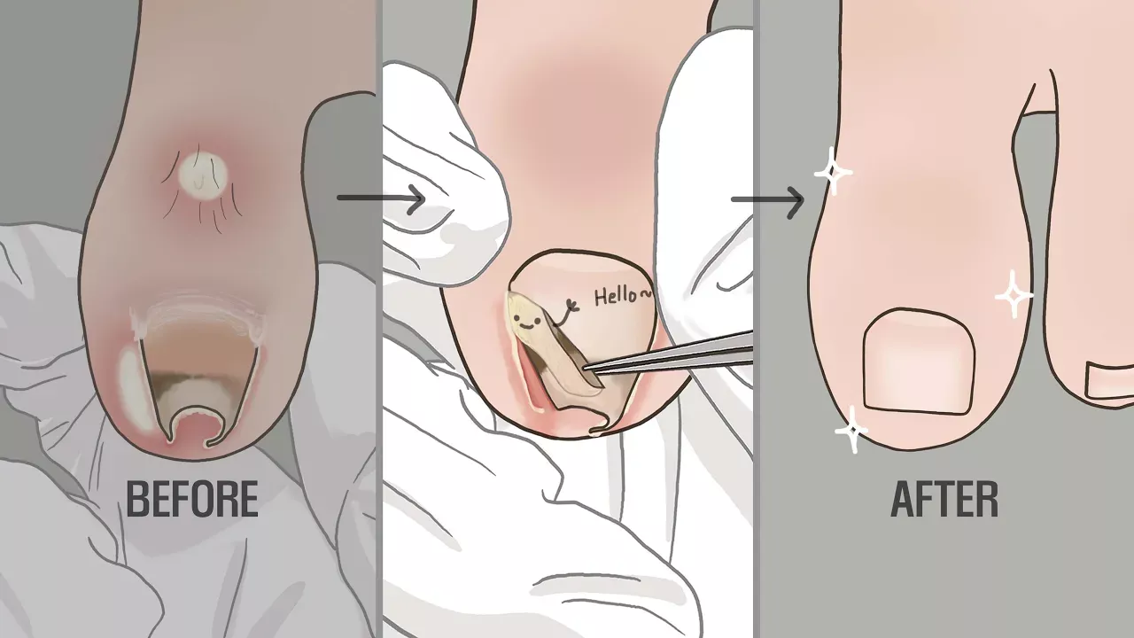 EP.2 Animation ASMR Tingle! Traitement d'élimination des ongles incarnés avec son stimulant LULUPANG