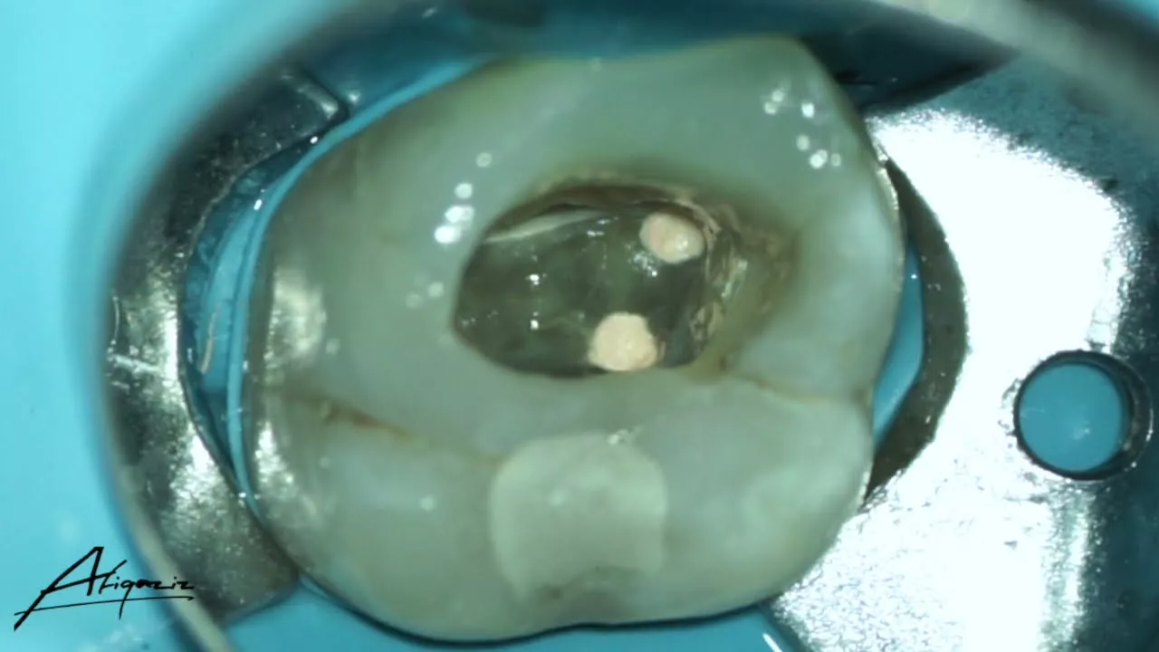 Obturation phase of the root canal treatment of maxillary second molar