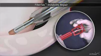 FiberTak™ Instability Repair